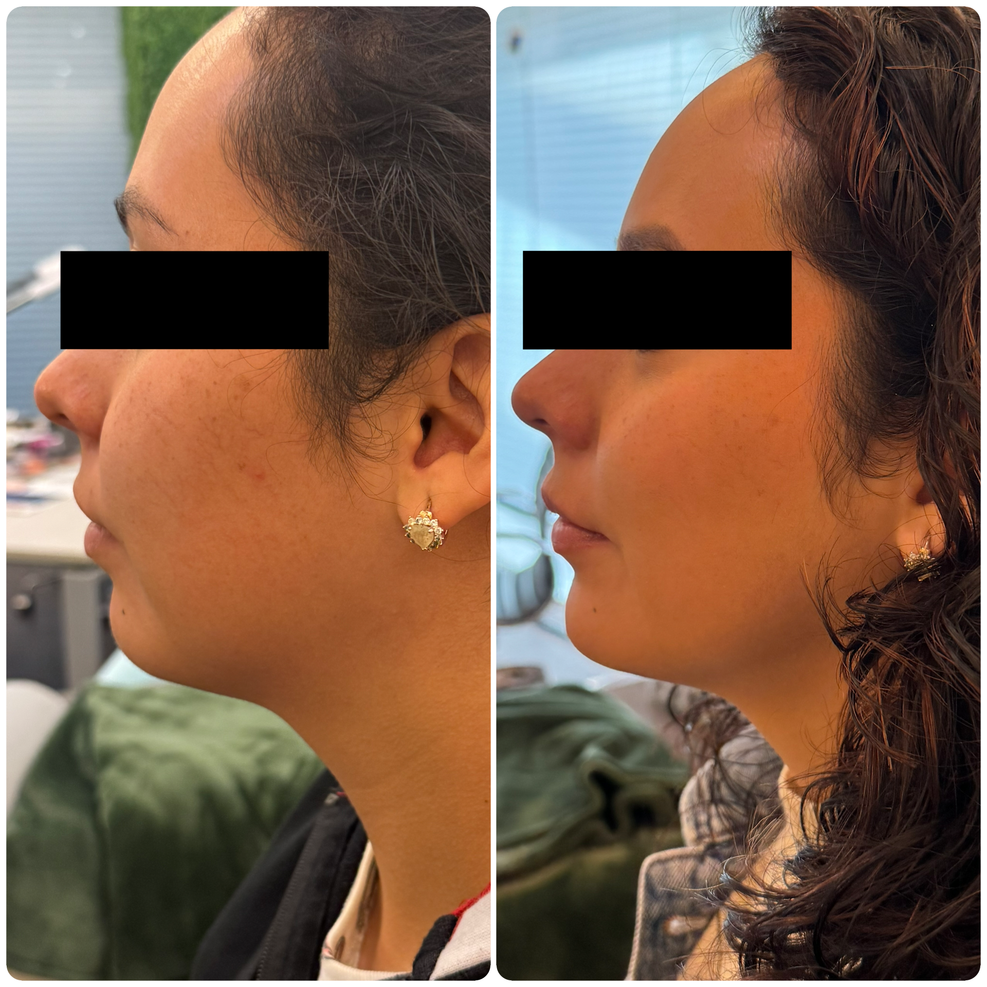 Adipoestructuración facial — Seleah Zona Esmeralda