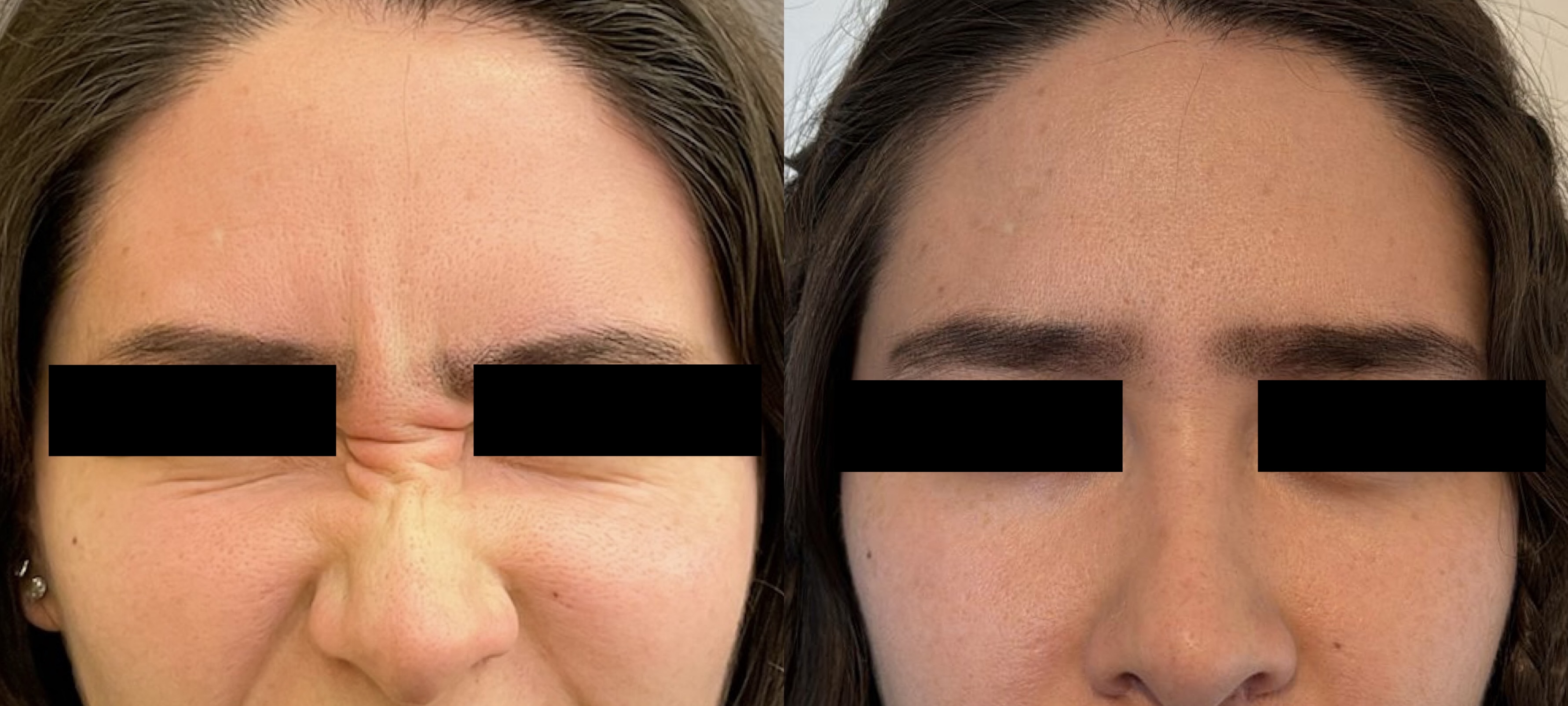 Botox toxina botulínica — Seleah Zona Esmeralda