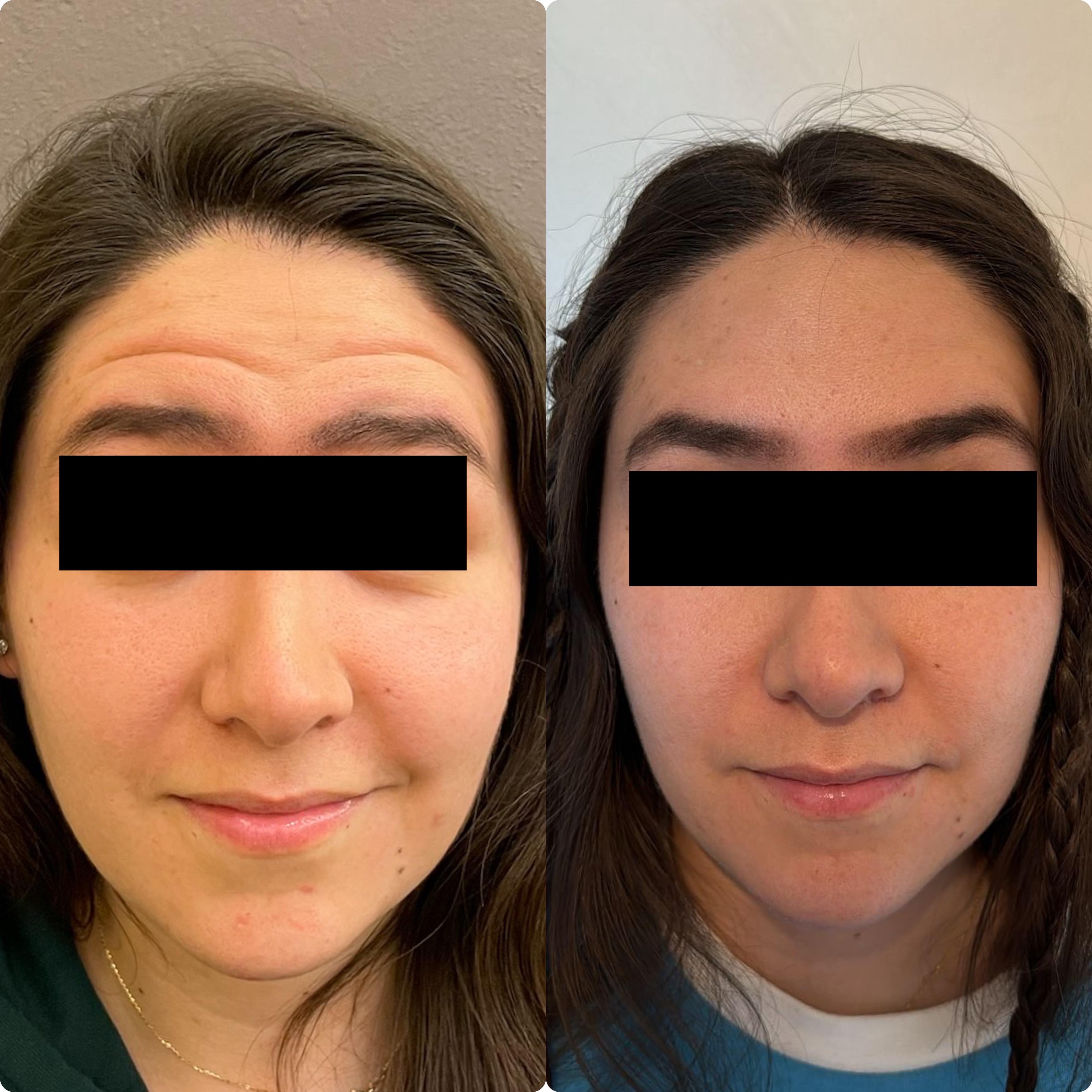 Antes y después Botox frente — Seleah Zona Esmeralda