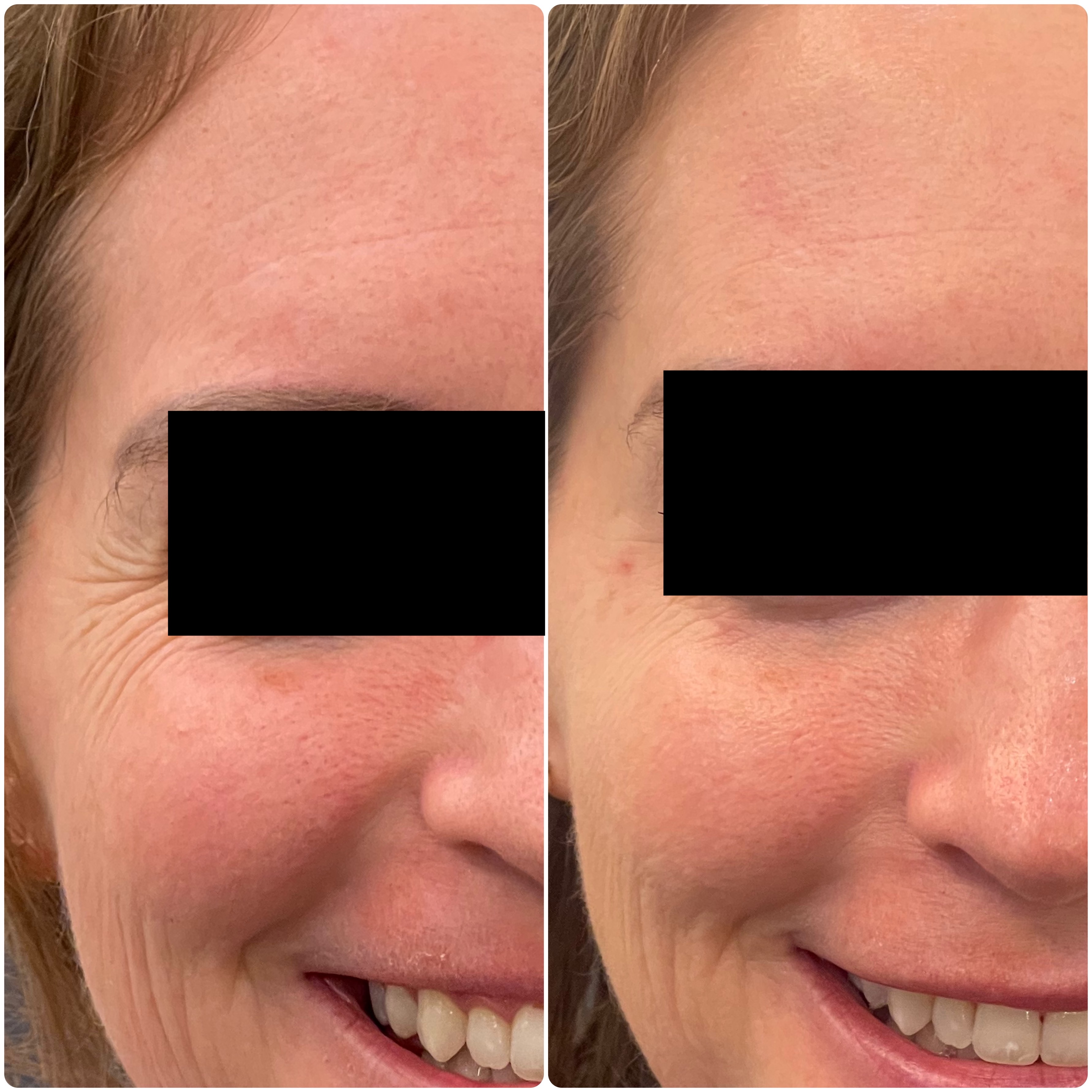 Antes y después Botox patas de gallo — Seleah Zona Esmeralda