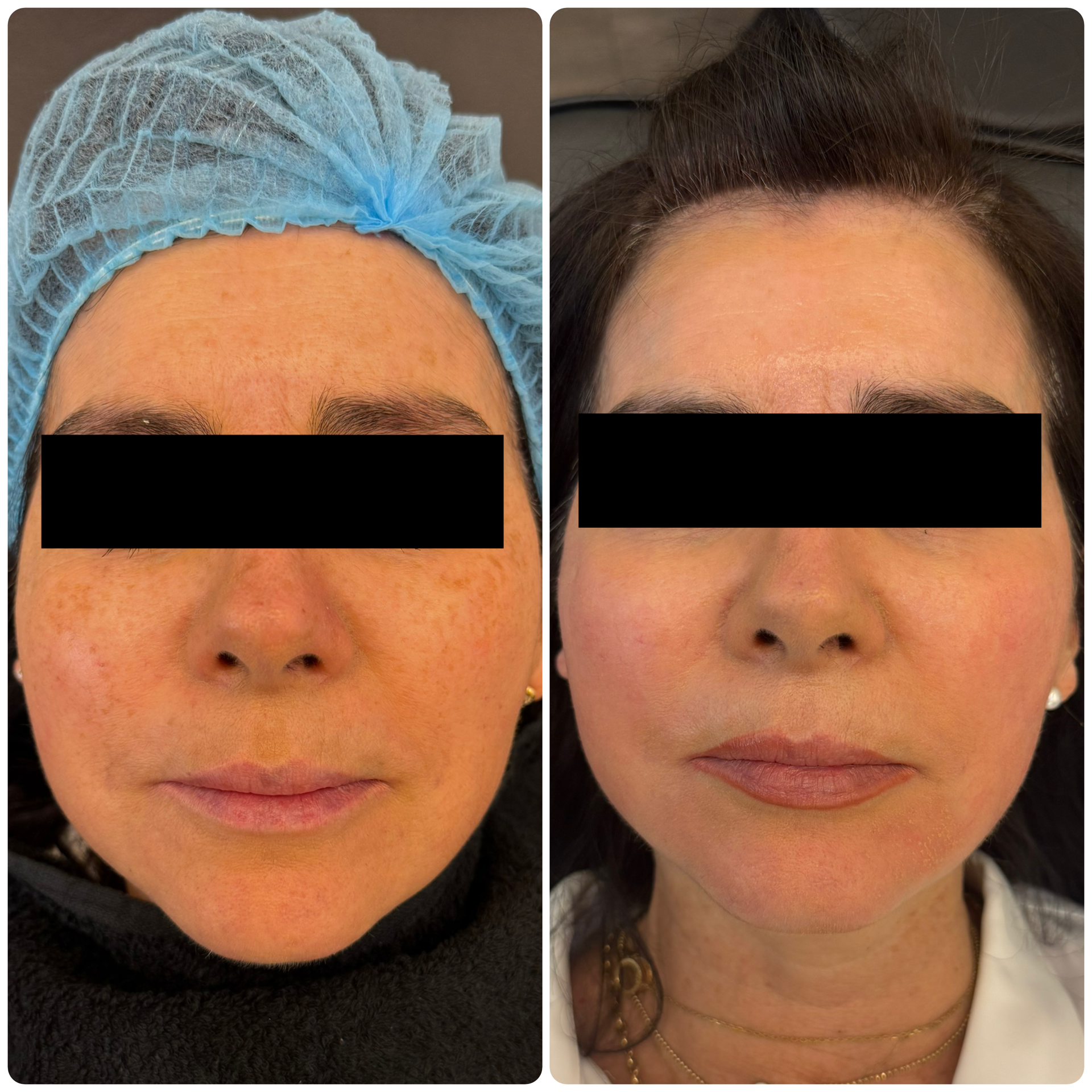 Cosmelan manchas melasma — Seleah Zona Esmeralda