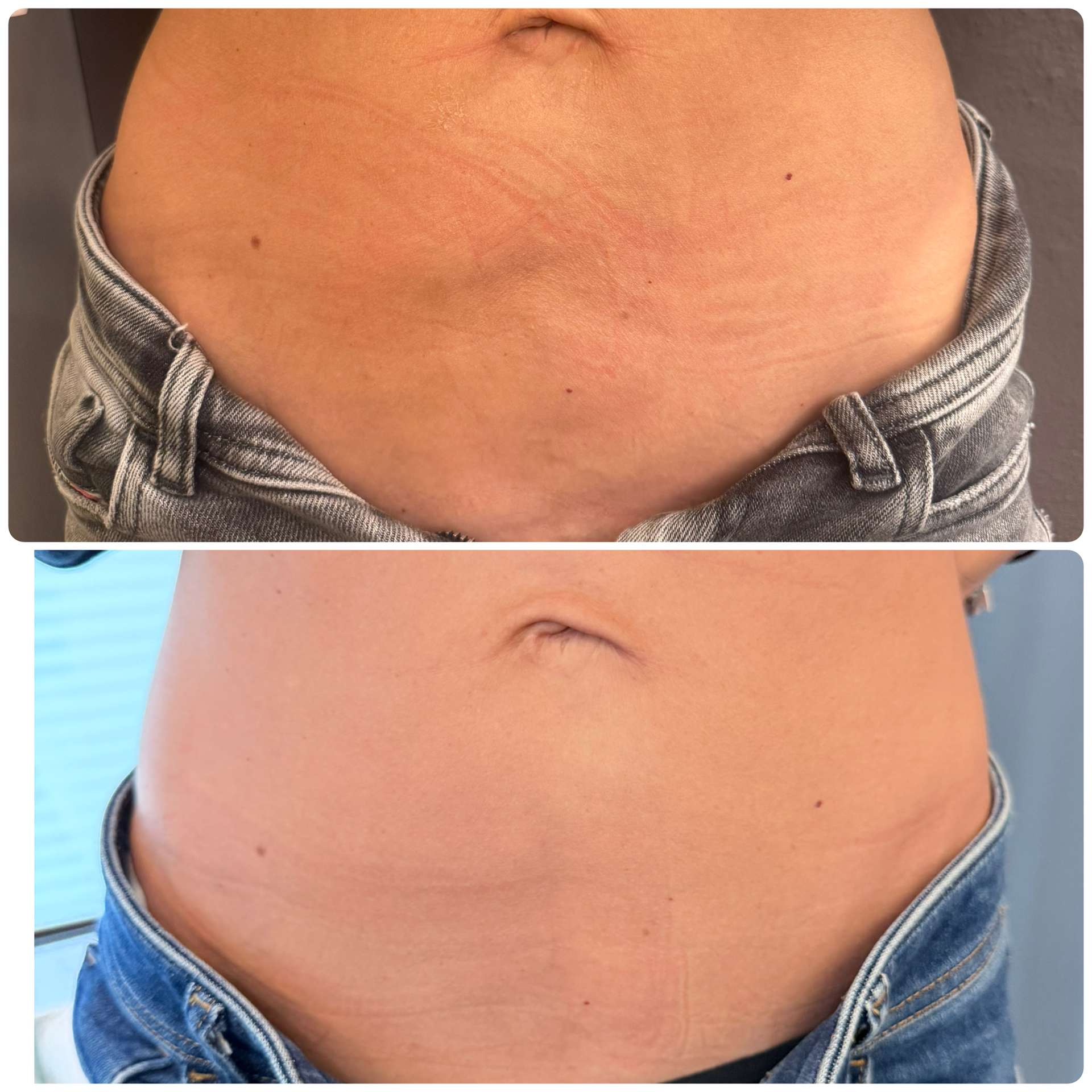 Antes y después enzimas lipolíticas fibrosis — Seleah Zona Esmeralda