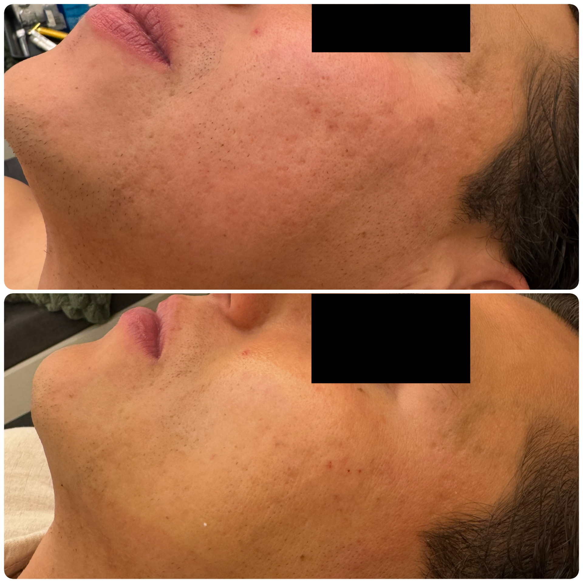 Exosomas faciales regeneración — Seleah Zona Esmeralda
