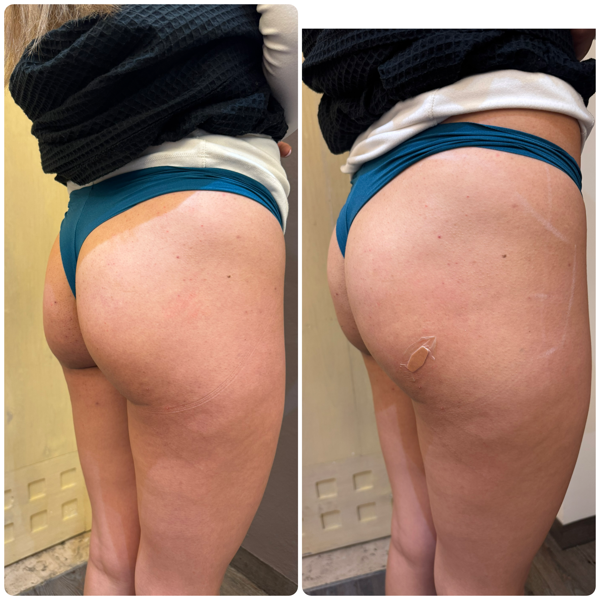 Antes y después relleno glúteos Velvet — Seleah Zona Esmeralda
