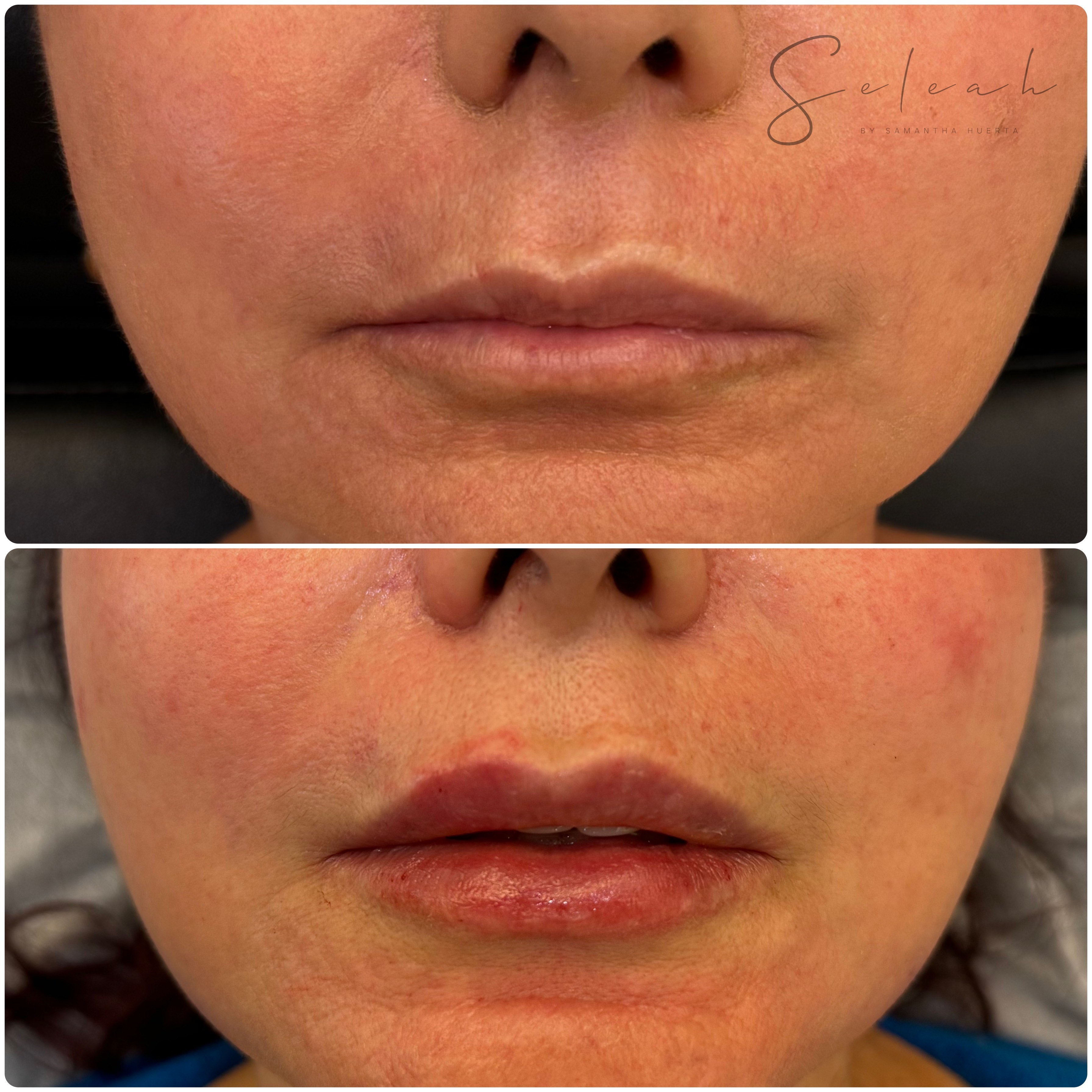 Aumento de Labios — Seleah Zona Esmeralda