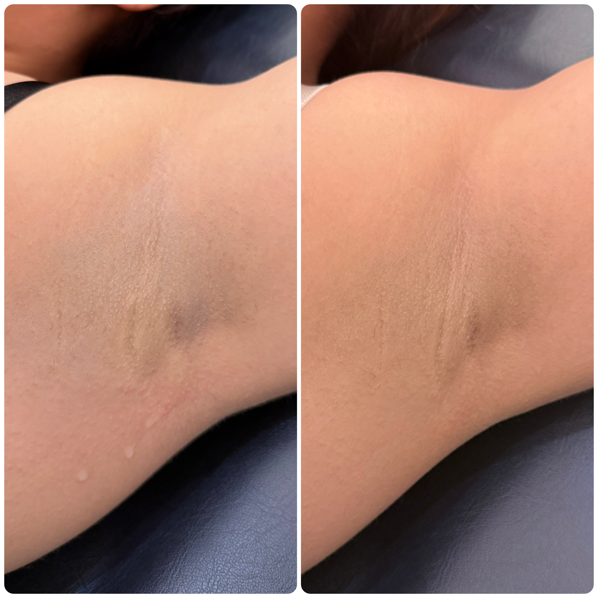 Antes y después peeling axila despigmentación — Seleah Zona Esmeralda