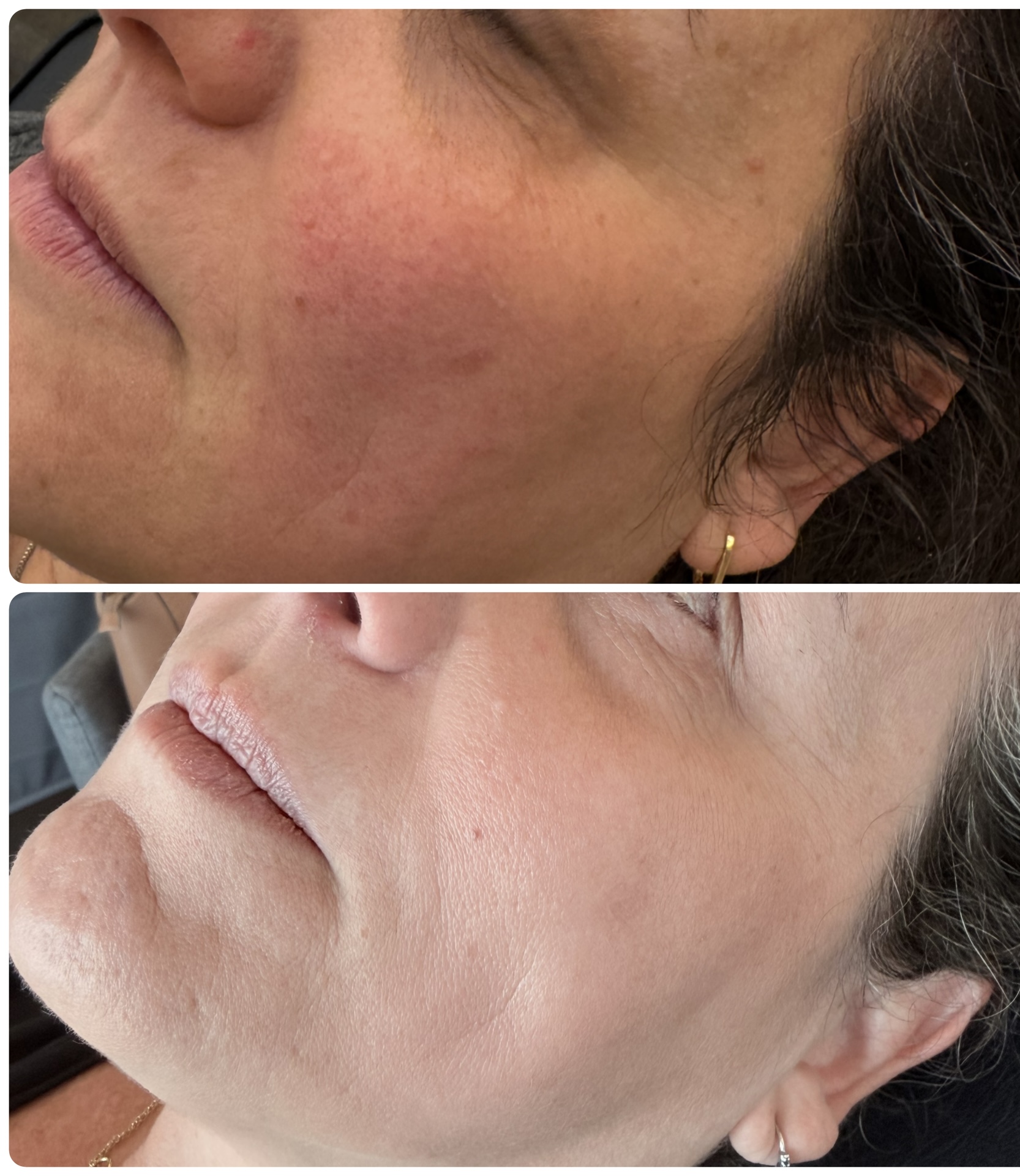 Peelings médicos faciales — Seleah Zona Esmeralda