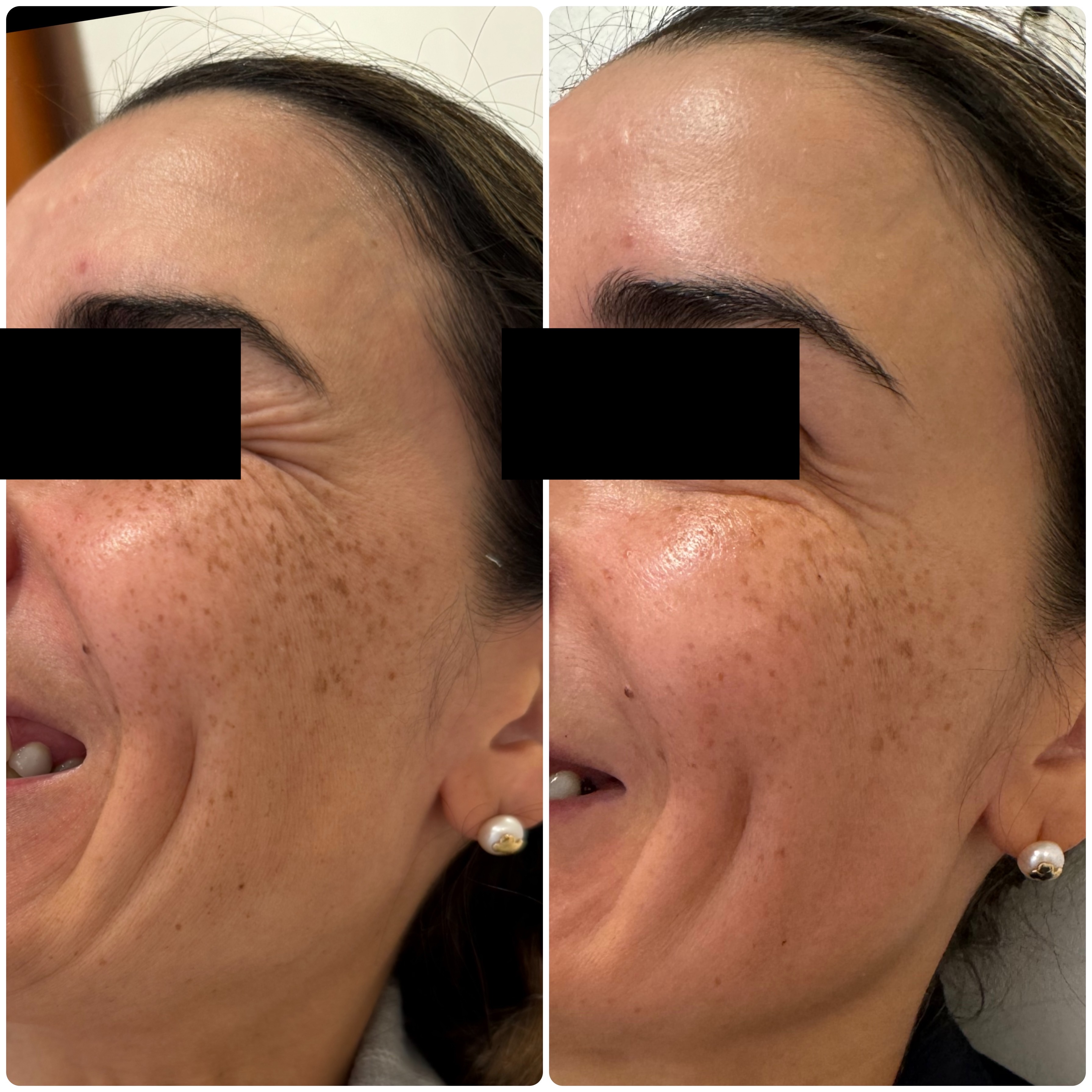 Antes y después Profhilo biorreestructuración facial — Seleah Zona Esmeralda