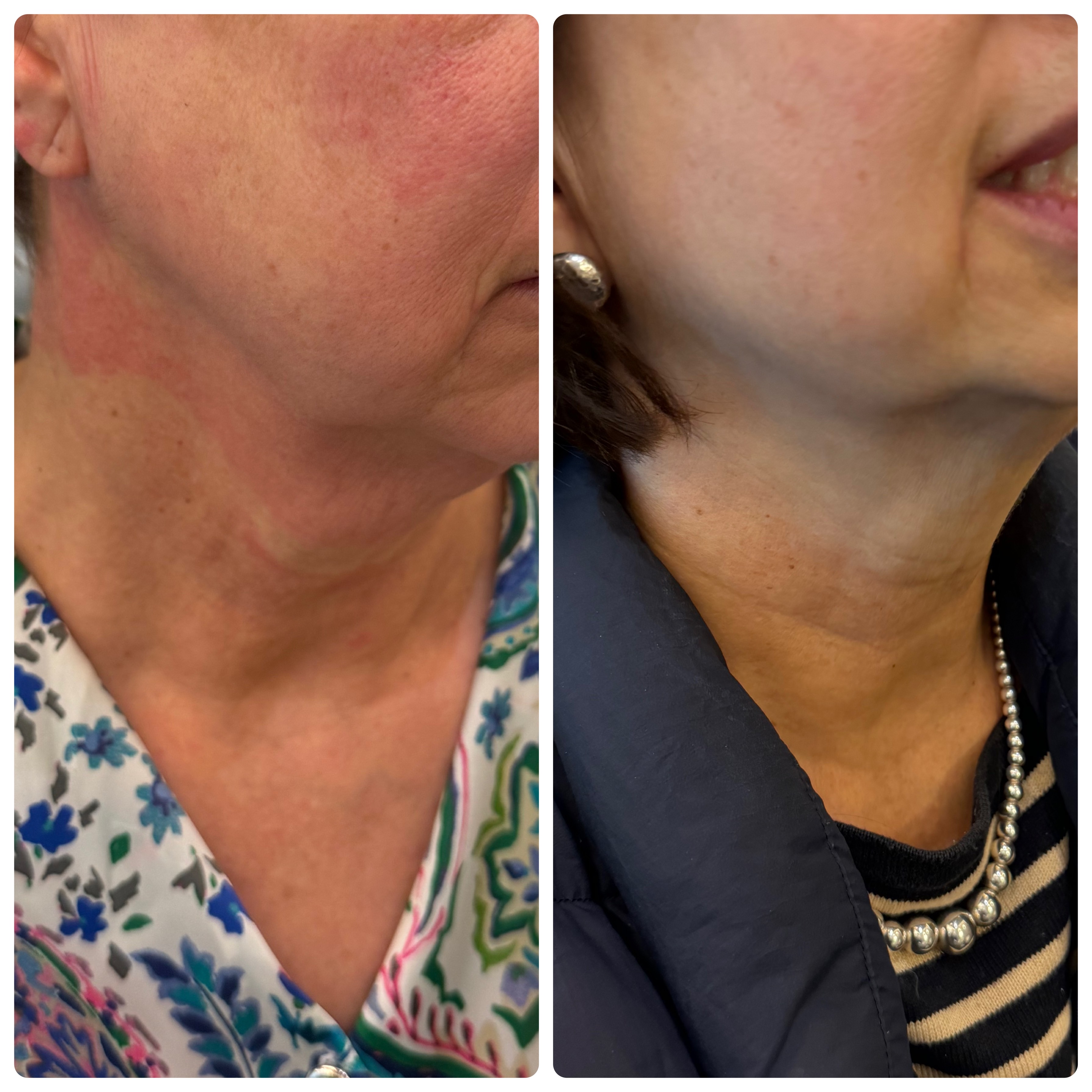 Antes y después Profhilo cuello — Seleah Zona Esmeralda