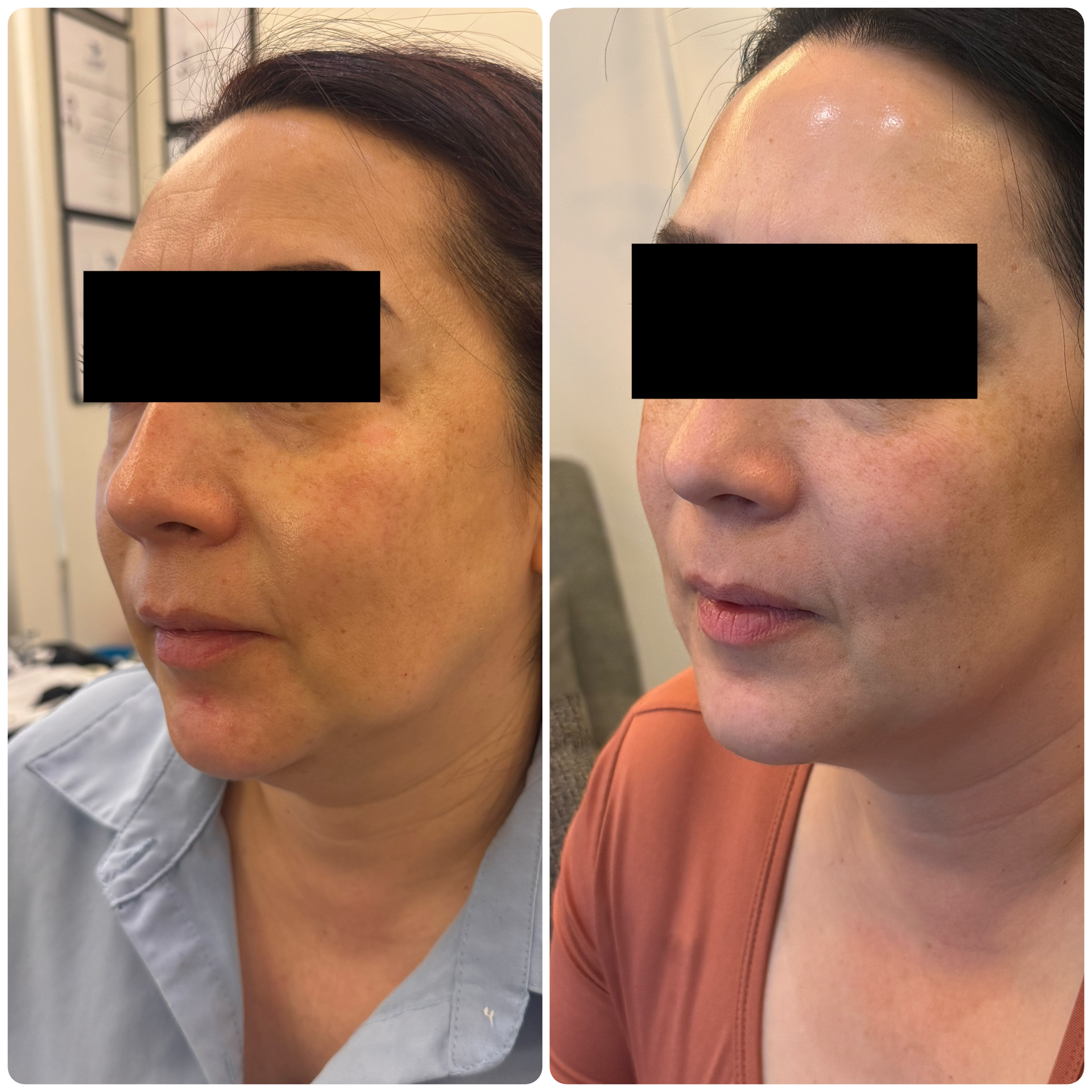 Radiesse bioestimulador facial — Seleah Zona Esmeralda