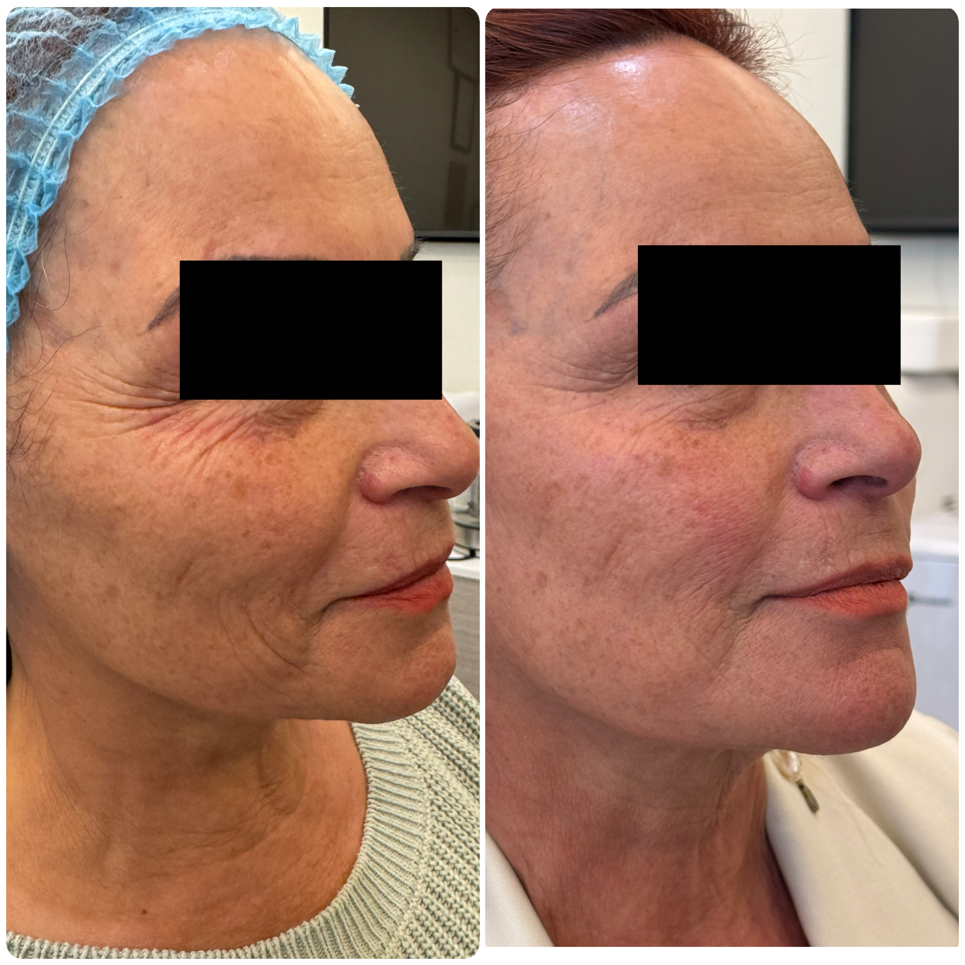 Antes y después Sculptra restauración de volumen facial — Seleah Zona Esmeralda