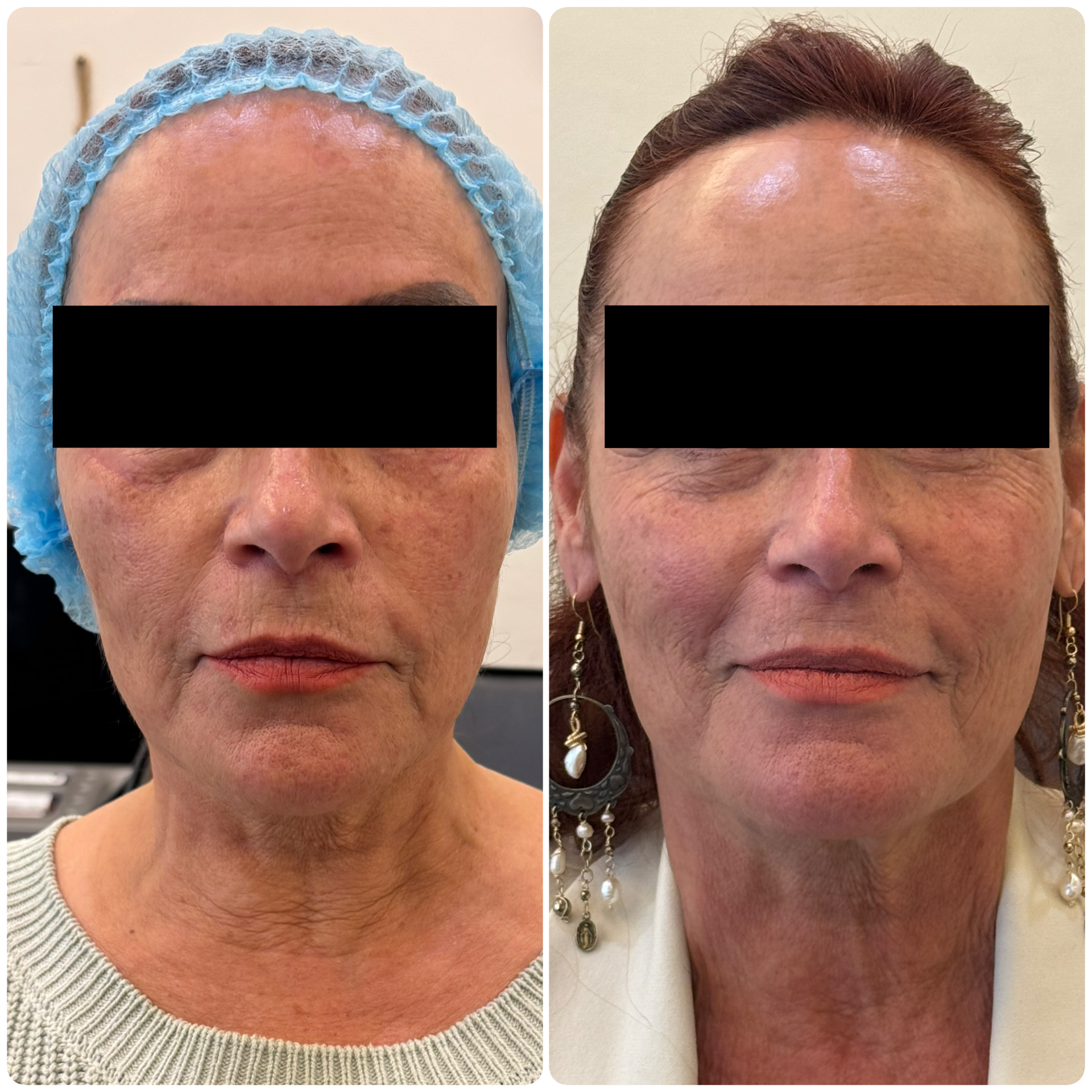 Antes y después Sculptra bioestimulación colágeno — Seleah Zona Esmeralda