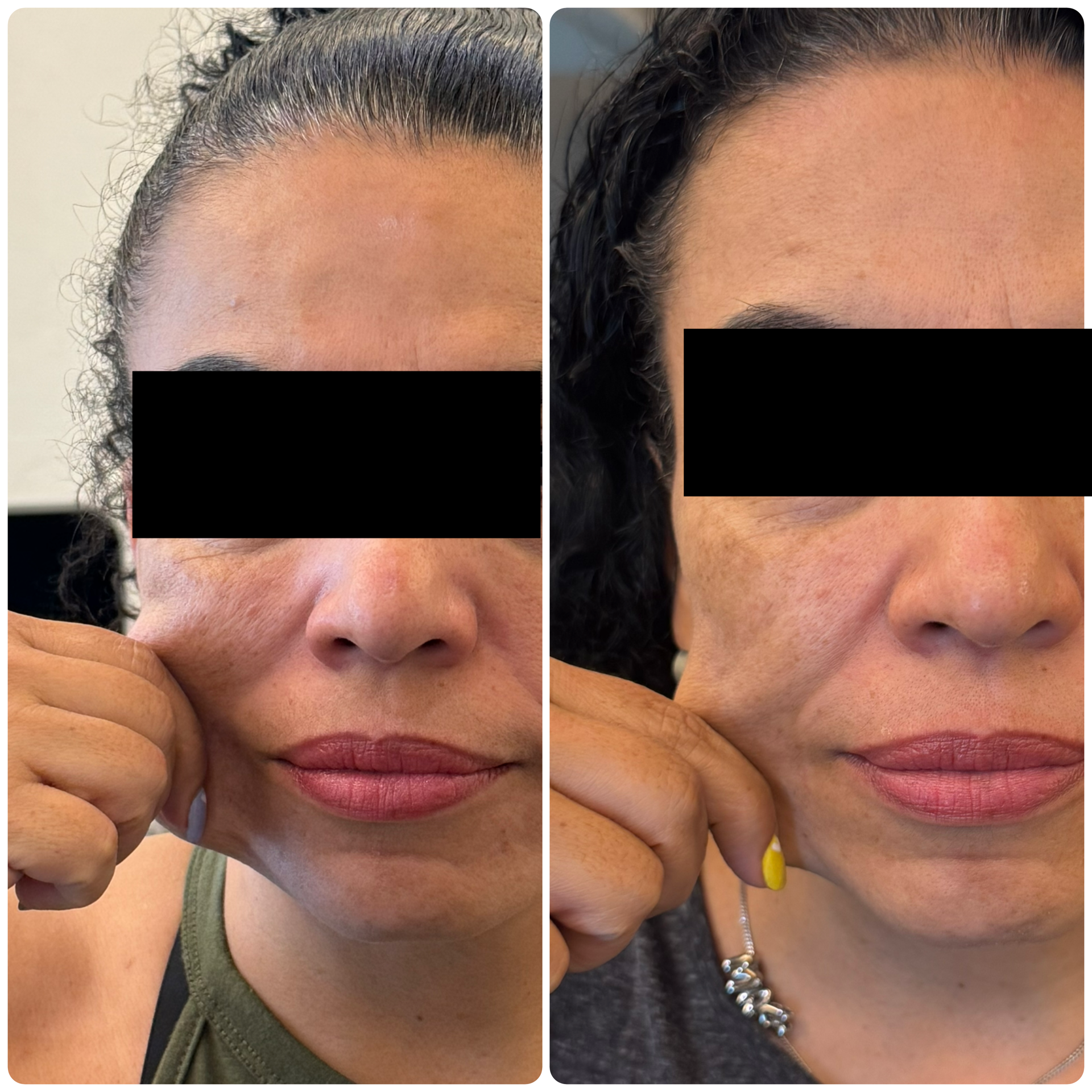 Antes y después Sculptra ácido poliláctico bioestimulador — Seleah Zona Esmeralda