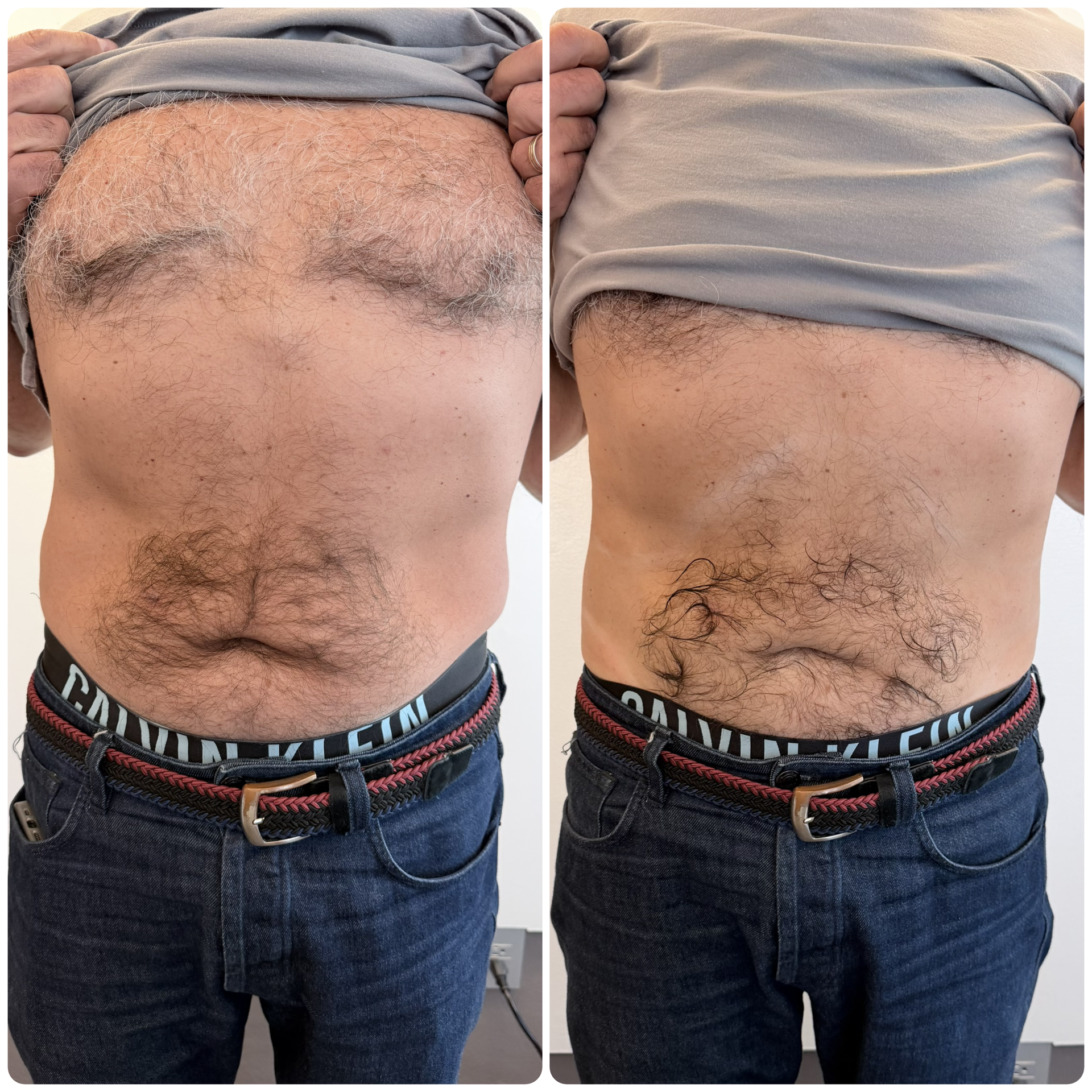 Antes y después Ultraformer MPT abdomen — Seleah Zona Esmeralda