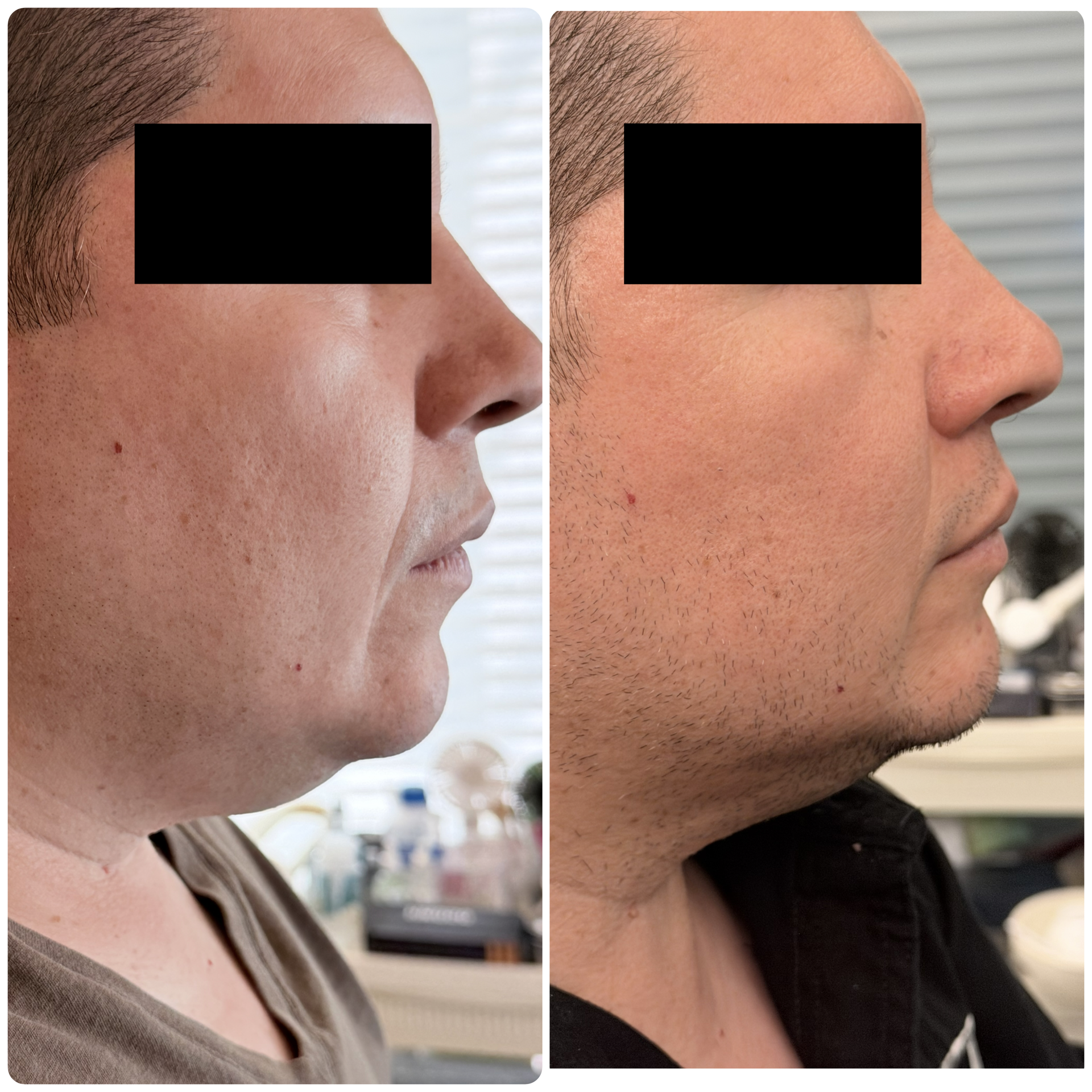 Antes y después Ultraformer cuello y papada — Seleah Zona Esmeralda