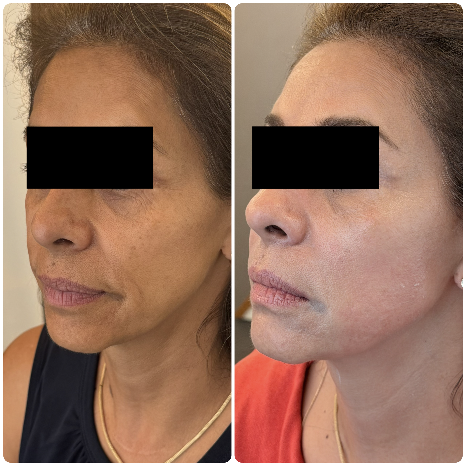 Antes y después Ultraformer MPT lifting facial — Seleah Zona Esmeralda